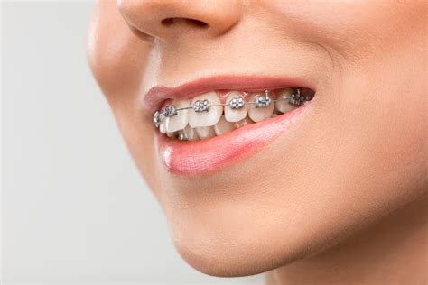 los brackets son de metal|¿De qué material están hechos los brackets más .